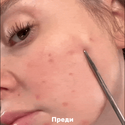 LUMI Glow Shot с Микроигли